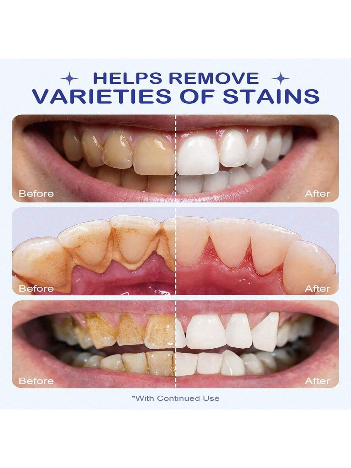 Teeth Whitening Kit Formula