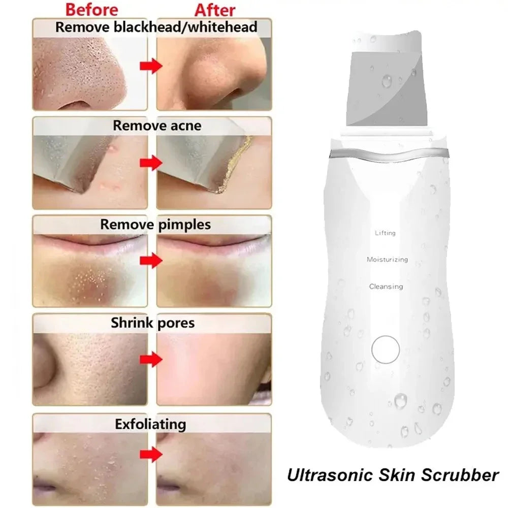 Ultrasonic Blackhead Remover Facial Cleaner