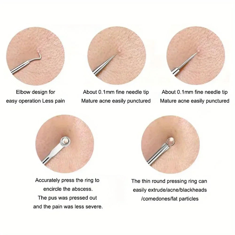 Blackhead Acne Pimple Extractor Kit